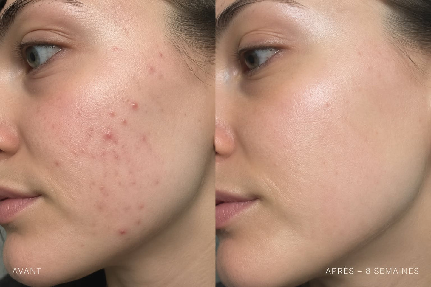 Sérum pour le visage - Peau mixte à acnéique